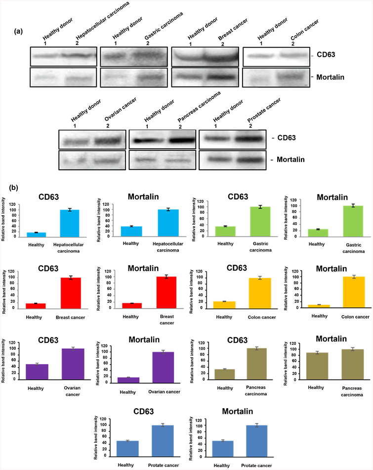 Characterization of Exosomes in Plasma of Patients with Breast, Ovarian, Prostate, Hepatic, Gastric, Colon, and Pancreatic Cancers.