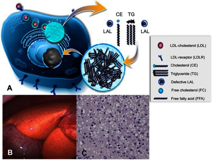 Lysosomal acid lipase deficiency - early diagnosis is the key.