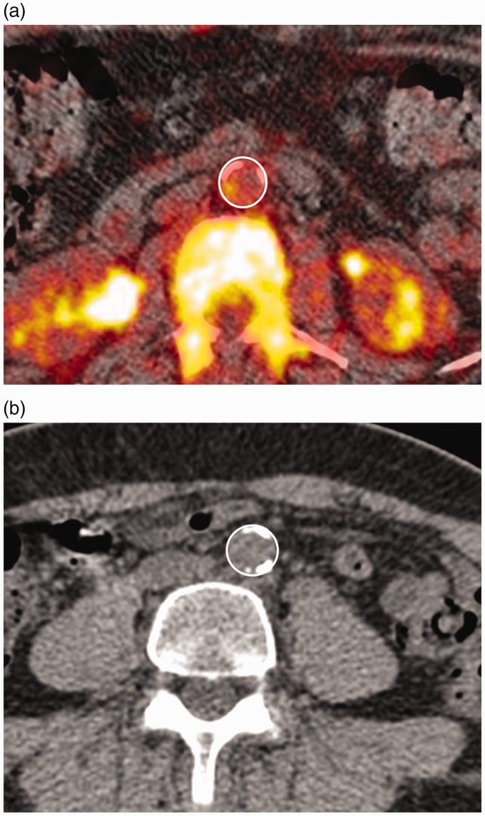 Evaluation of aortic <sup>18</sup>F-NaF tracer uptake using PET/CT as a predictor of aortic calcification in postmenopausal women: A longitudinal study.