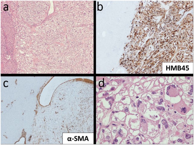 Challenging liver lesions in noncirrhotic patients: Report of three cases.