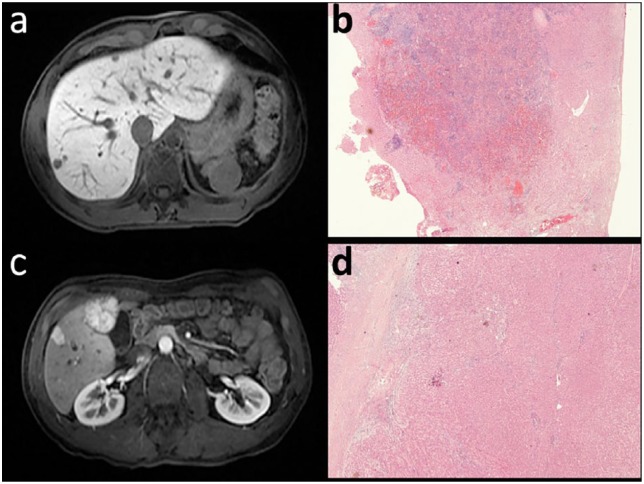 Challenging liver lesions in noncirrhotic patients: Report of three cases.