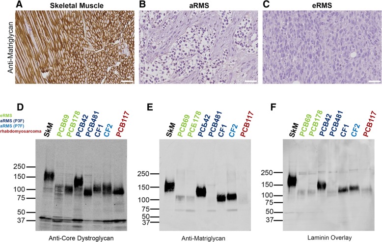 Exogenous expression of the glycosyltransferase LARGE1 restores α-dystroglycan matriglycan and laminin binding in rhabdomyosarcoma.