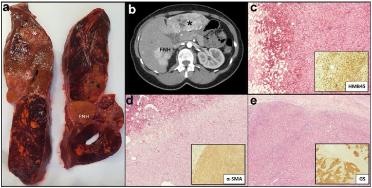 Challenging liver lesions in noncirrhotic patients: Report of three cases.