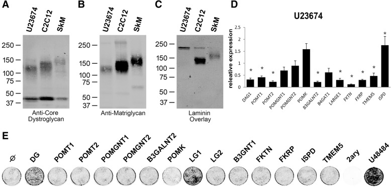 Exogenous expression of the glycosyltransferase LARGE1 restores α-dystroglycan matriglycan and laminin binding in rhabdomyosarcoma.