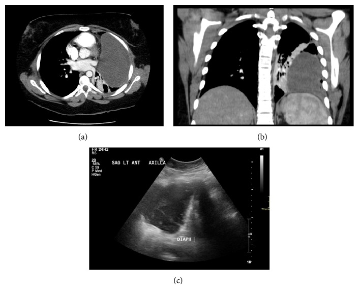 Case Report of a Rare Cystic Mediastinal Lymphangioma Mimicking Recurrent Pleural Effusion.