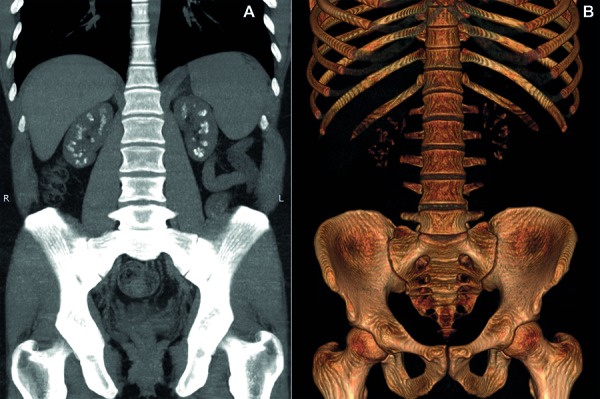 Atypical presentation of familial hypomagnesemia with hypercalciuria and nephrocalcinosis in a patient with a new claudin-16 gene mutation.