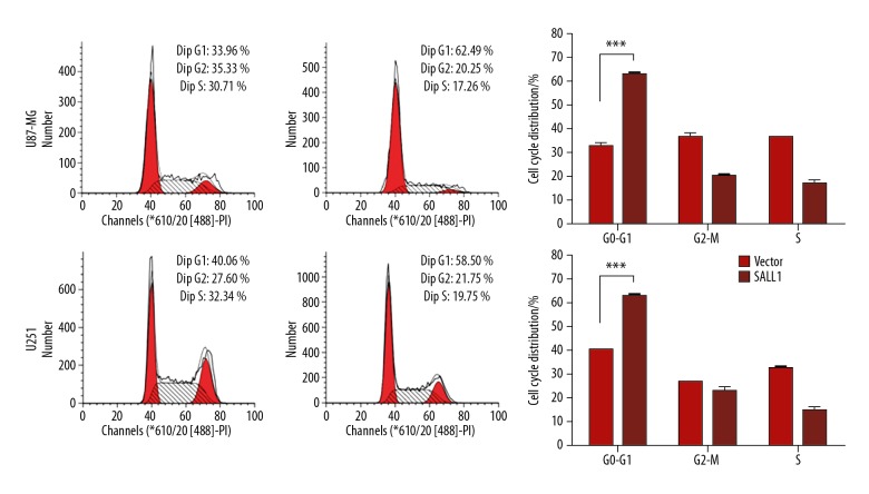 Spalt-Like Transcription Factor 1 (SALL1) Gene Expression Inhibits Cell Proliferation and Cell Migration of Human Glioma Cells Through the Wnt/β-Catenin Signaling Pathway.