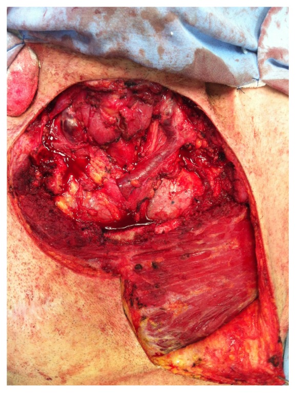 Sternectomy for Treating Advanced Non-Melanoma Skin Cancer.