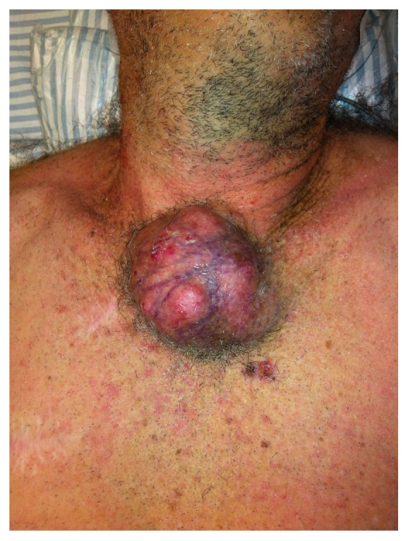 Sternectomy for Treating Advanced Non-Melanoma Skin Cancer.