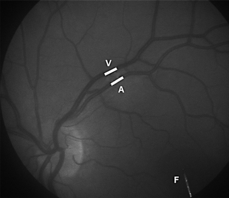 The Diameter of Retinal Arterioles Is Unaffected by Intravascular Administration of the Adenosine A<sub>2A</sub> Receptor Agonist Regadenoson in Normal Persons.