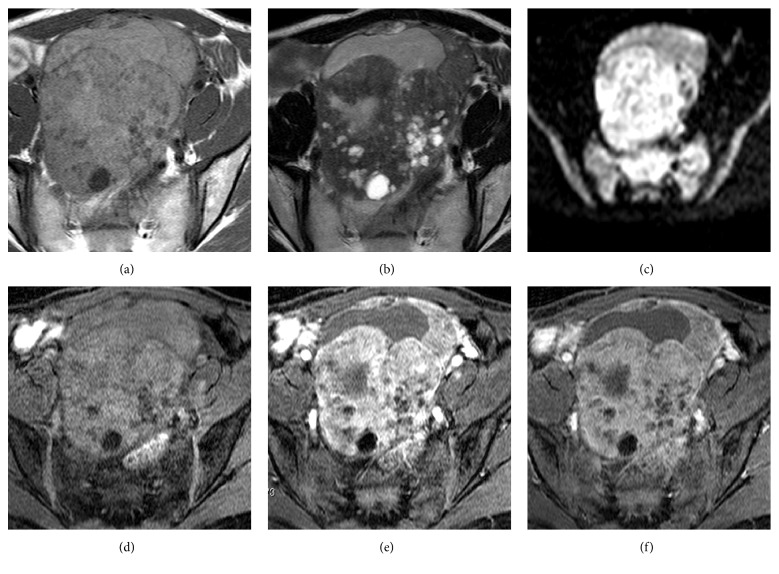 An Unusual Ovarian Mucinous Borderline Tumor with a Large Solid Component.