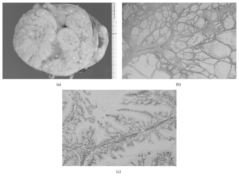 An Unusual Ovarian Mucinous Borderline Tumor with a Large Solid Component.