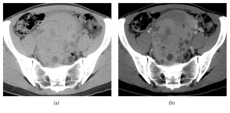 An Unusual Ovarian Mucinous Borderline Tumor with a Large Solid Component.