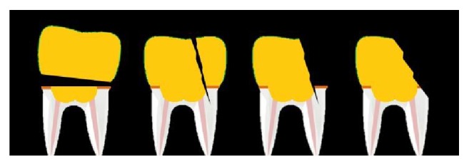 Fracture Resistance of CAD/CAM Lithium Disilicate of Endodontically Treated Mandibular Damaged Molars Based on Different Preparation Designs.