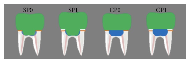 Fracture Resistance of CAD/CAM Lithium Disilicate of Endodontically Treated Mandibular Damaged Molars Based on Different Preparation Designs.