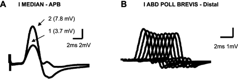 Lambert-Eaton Myasthenic syndrome: early diagnosis is key.