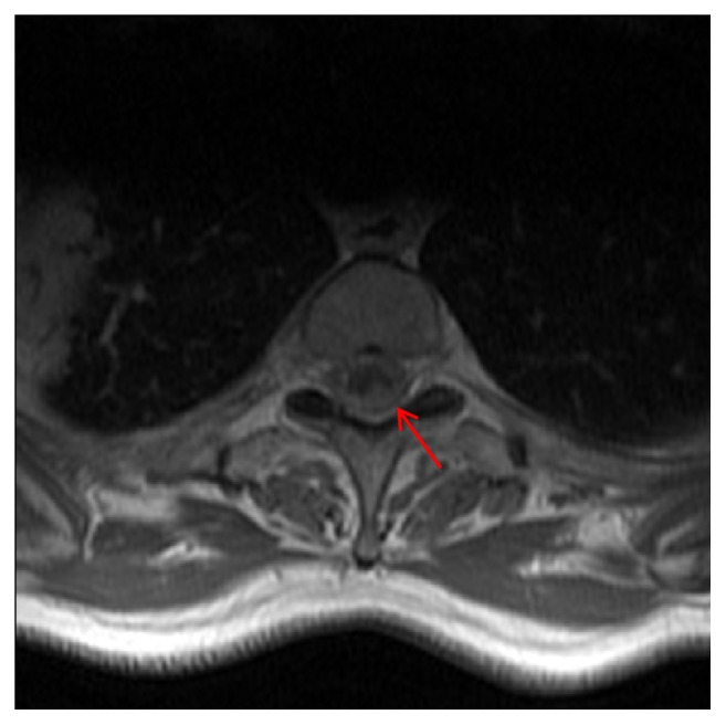 Dural and Leptomeningeal Spine Metastases of Breast Cancer.