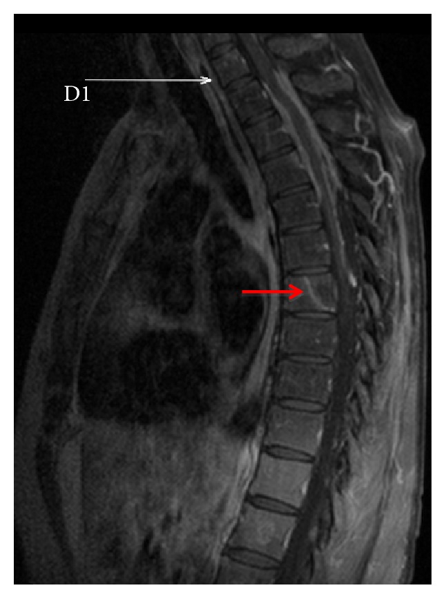 Dural and Leptomeningeal Spine Metastases of Breast Cancer.