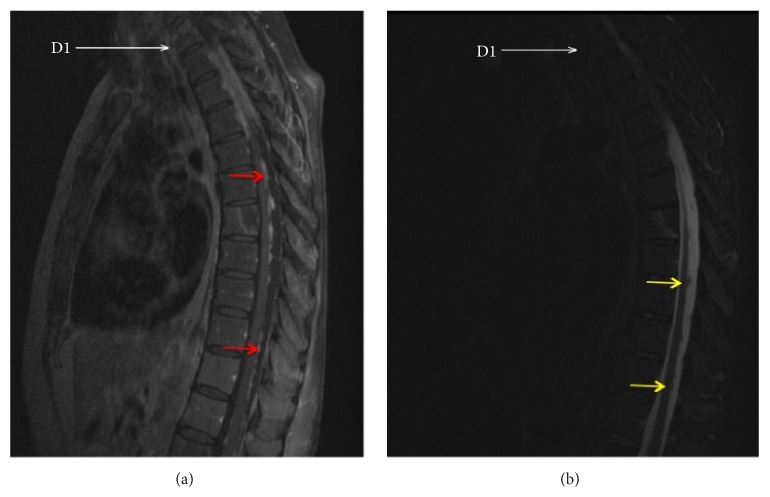 Dural and Leptomeningeal Spine Metastases of Breast Cancer.