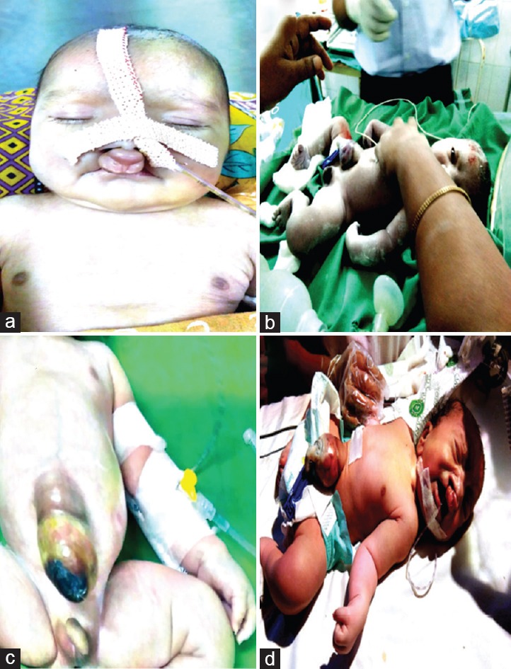 A Child with Partial Trisomy 4 (q26 - qterminal) Resulting from Paternally Inherited Translocation (4:18) Associated with Multiple Congenital Anomalies and Death.