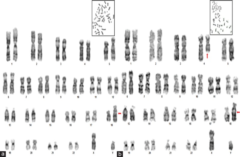 A Child with Partial Trisomy 4 (q26 - qterminal) Resulting from Paternally Inherited Translocation (4:18) Associated with Multiple Congenital Anomalies and Death.