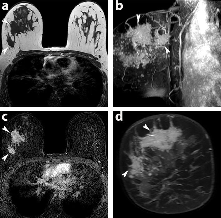Hyperpolarised <sup>13</sup>﻿C MRI: a new horizon for non-invasive diagnosis of aggressive breast cancer.
