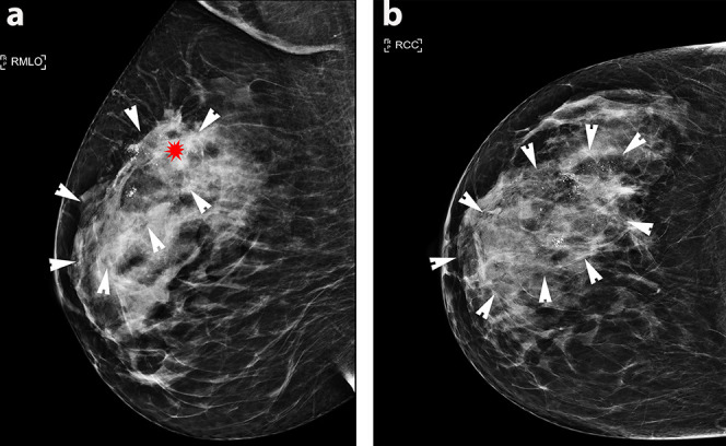 Hyperpolarised <sup>13</sup>﻿C MRI: a new horizon for non-invasive diagnosis of aggressive breast cancer.