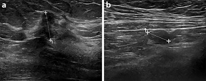 Hyperpolarised <sup>13</sup>﻿C MRI: a new horizon for non-invasive diagnosis of aggressive breast cancer.