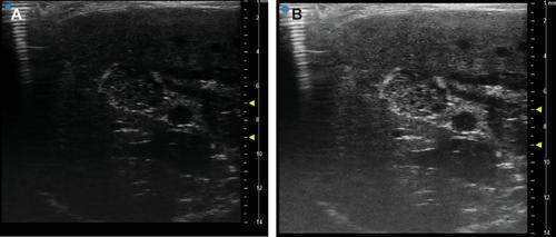 Ultrasound-Guided Approaches to Improve Orthotopic Mouse Xenograft Models for Hepatocellular Carcinoma