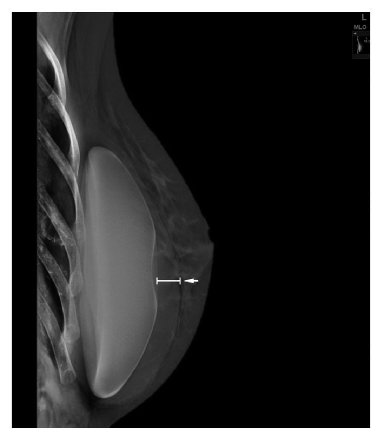 Description of Two Cases of Anaplastic Large Cell Lymphoma Associated with a Breast Implant.