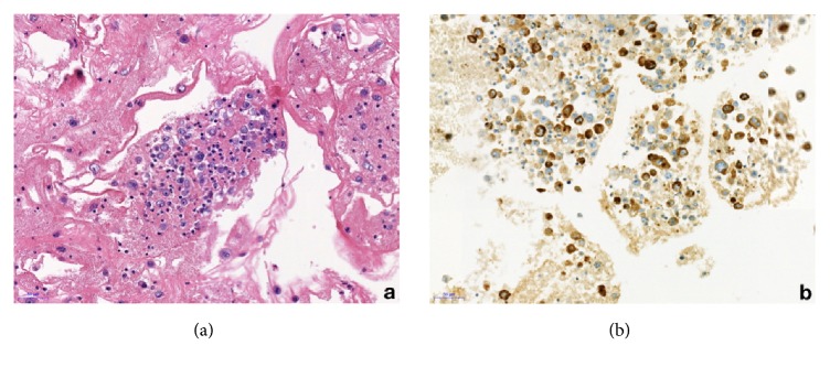 Description of Two Cases of Anaplastic Large Cell Lymphoma Associated with a Breast Implant.