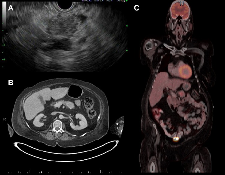 Adrenocorticotropin Hormone Secreting Carcinoma of the Pancreas: A Case Report.