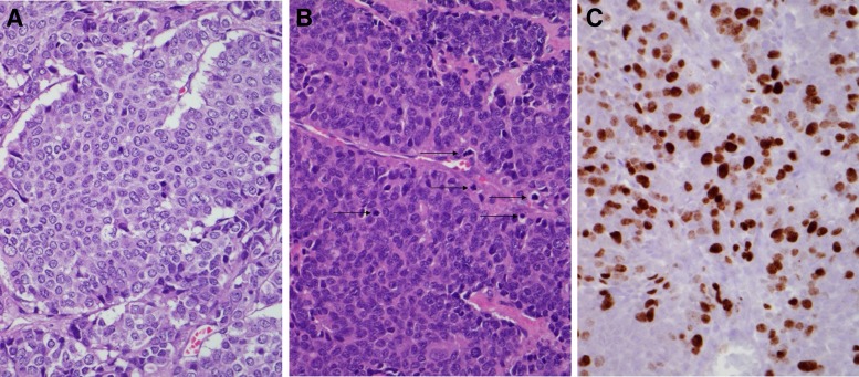 Adrenocorticotropin Hormone Secreting Carcinoma of the Pancreas: A Case Report.