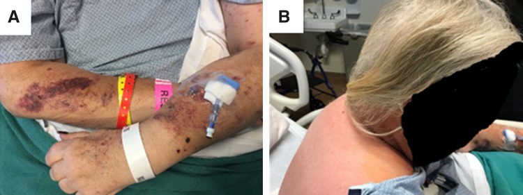 Adrenocorticotropin Hormone Secreting Carcinoma of the Pancreas: A Case Report.