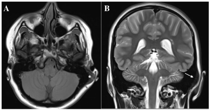 Low-Grade Surface Osteosarcoma of the Temporal Bone in Paediatric Patients: A Case Report and Literature Review.