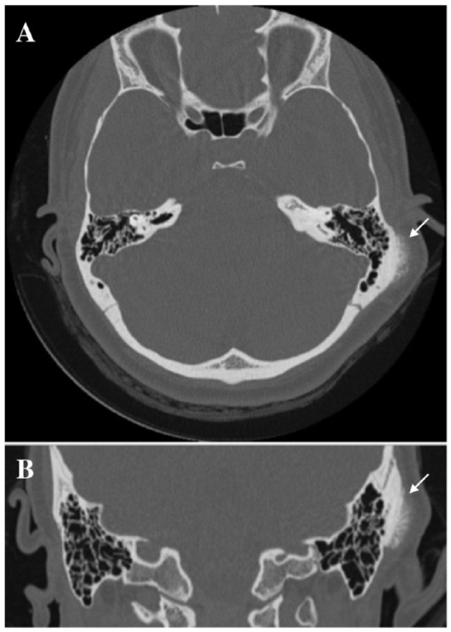 Low-Grade Surface Osteosarcoma of the Temporal Bone in Paediatric Patients: A Case Report and Literature Review.