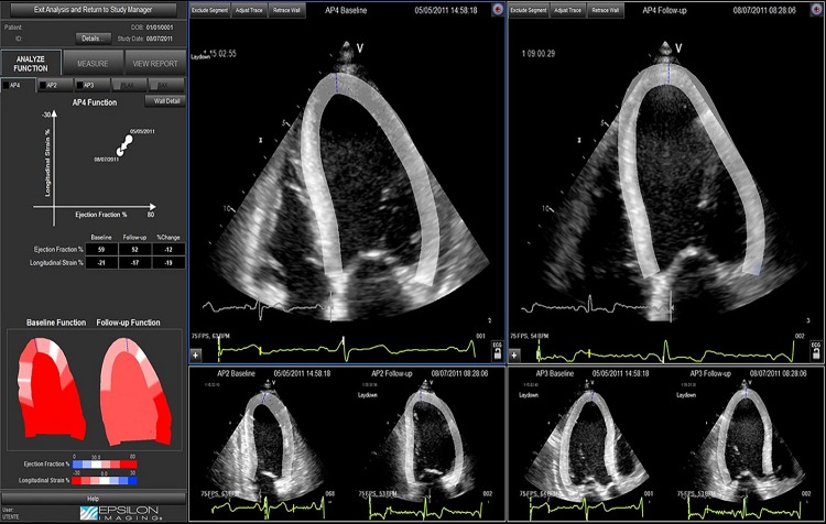 Longitudinal strain analysis allows the identification of subclinical deterioration of right ventricular function in patients with cancer therapy-related left ventricular dysfunction.