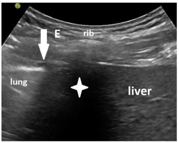 Sonographically Measured Improvement in Diaphragmatic Mobility and Outcomes Among Patients Requiring Prolonged Weaning from the Ventilator.
