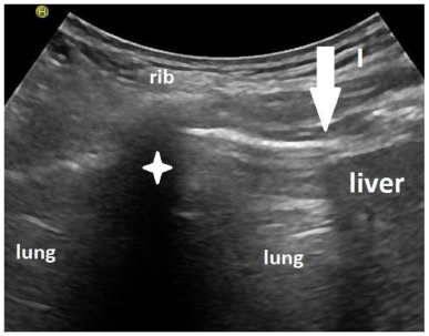 Sonographically Measured Improvement in Diaphragmatic Mobility and Outcomes Among Patients Requiring Prolonged Weaning from the Ventilator.
