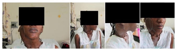 Endovascular Embolization of a Dissected External Carotid Artery Pseudoaneurysm in a Young Female with Neurofibromatosis Complicated by Preeclampsia.
