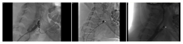 Endovascular Embolization of a Dissected External Carotid Artery Pseudoaneurysm in a Young Female with Neurofibromatosis Complicated by Preeclampsia.