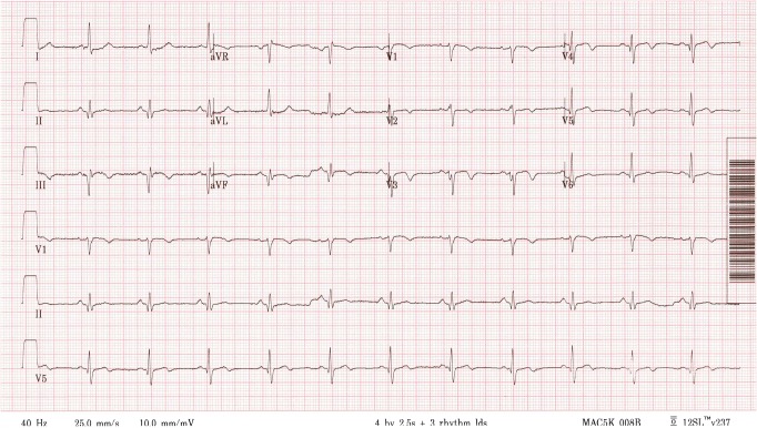 Anterior wall myocardial infarction in a young man caused by spontaneous dissection and hematoma of coronary artery.