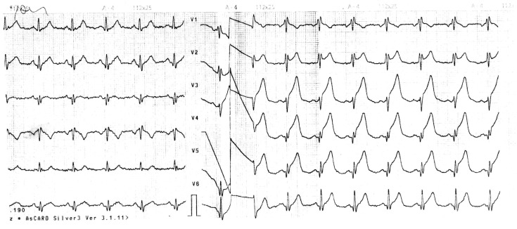 Anterior wall myocardial infarction in a young man caused by spontaneous dissection and hematoma of coronary artery.