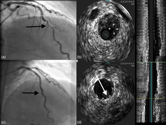 Anterior wall myocardial infarction in a young man caused by spontaneous dissection and hematoma of coronary artery.