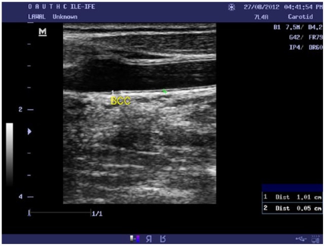 Carotid Intima-Media Thickness: A Surrogate Marker for Cardiovascular Disease in Chronic Kidney Disease Patients.