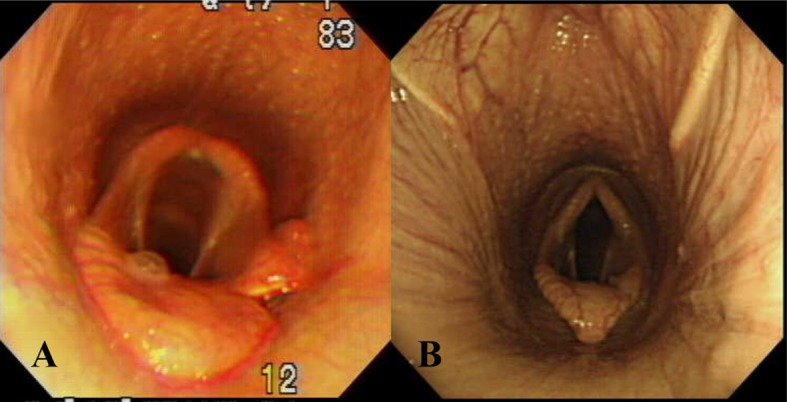 Surgical corrections and postsurgical complications of epiglottic entrapment in Thoroughbreds: 12 cases (2009-2015).