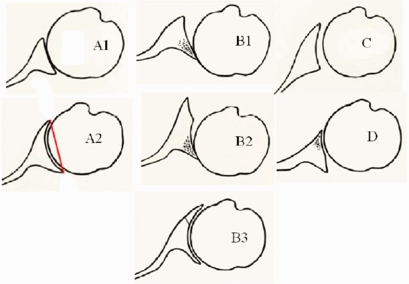 Autografting for B2 Glenoids.