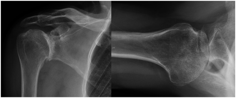 Autografting for B2 Glenoids.