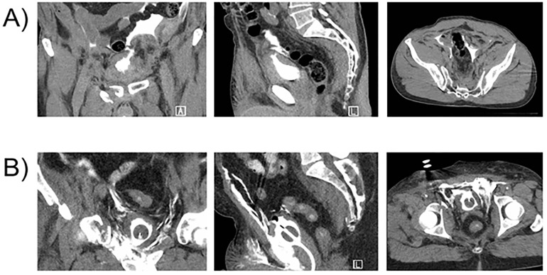 A contemporary review of adult bladder trauma.