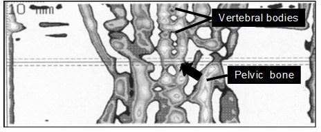 Effect of ovariectomy on proximal tibia metaphysis and lumbar vertebral body in common marmoset monkeys.